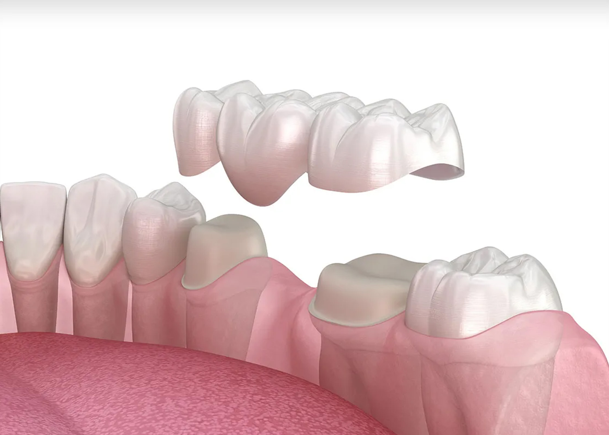 Dental Bridge