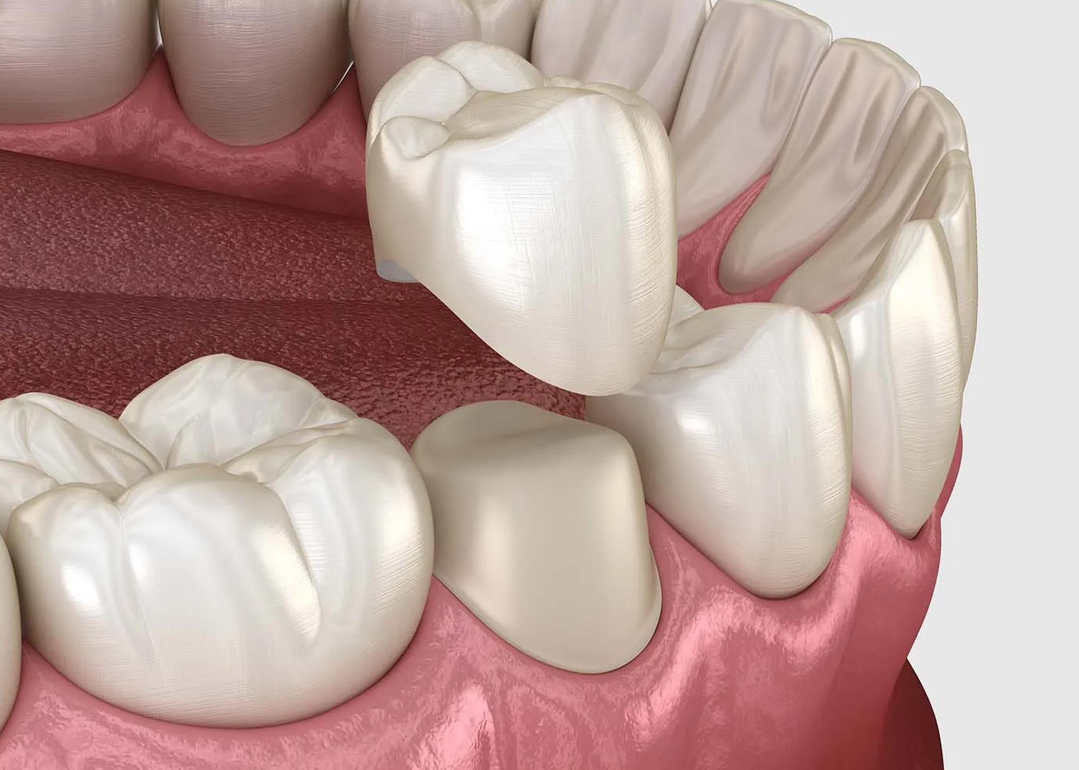 Dental Crown